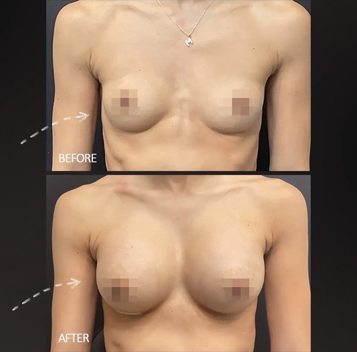 Before and after breast augmentation, front view, by Dr. Ronald Espinoza