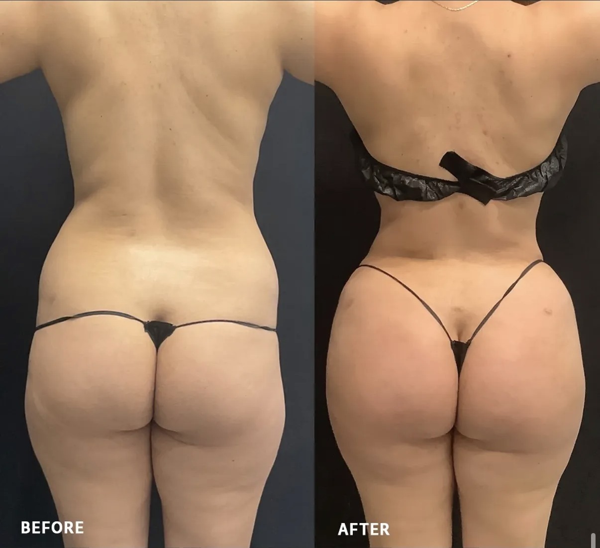 Before and after body contouring, back view, by Dr. Ronald Espinoza